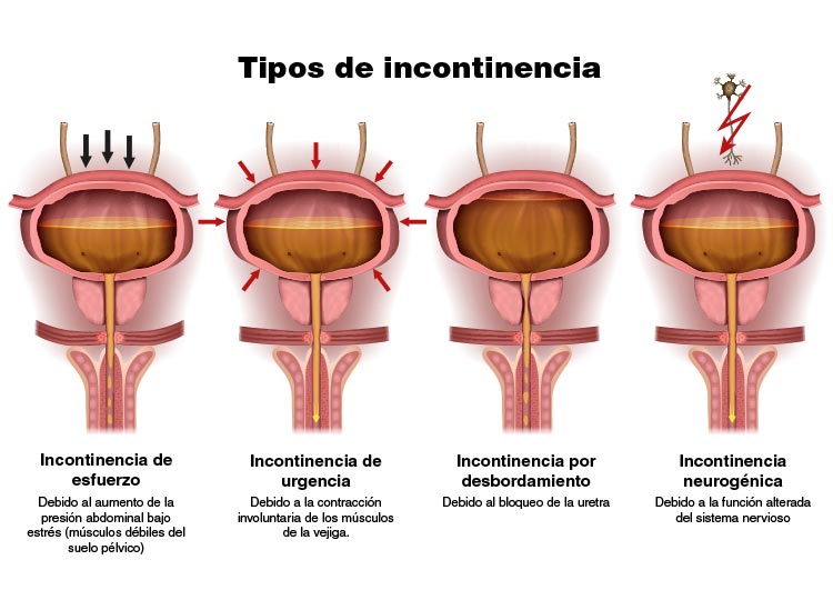Tipos de incontinencia urinaria en los hombres
