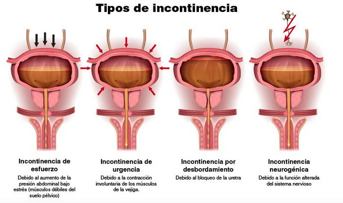 La incontinencia urinaria no es normal, en ninguna medida