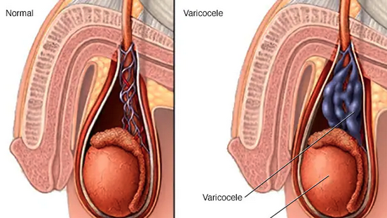 Relación entre varicocele, disfunción sexual y niveles séricos de testosterona